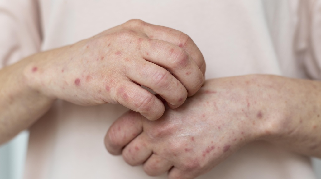 Hadapi Mpox, Menkes Pastikan Obat hingga Vaksin Tersedia di Indonesia